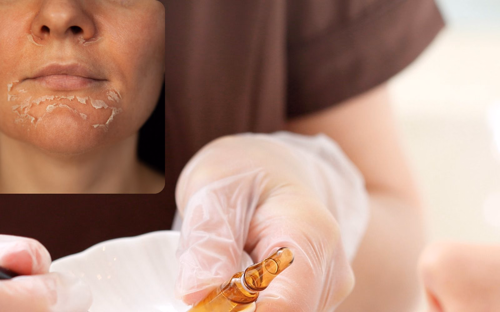 Peeling Facial